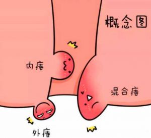【四院|科普】：痔疮术后疼痛的原因及处理