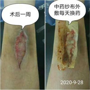 【四院|科普】：胫骨磕了下留下个小口怎么也好不了，上海一女子赶来四院求医