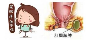 【四院|科普】：肛门旁边长了个包怎么办？让我们带您认识肛周脓肿