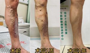 全国著名静脉曲张专家 梅家才5月湖州行程