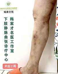【四院|科普】：静脉曲张人群需防范！冬季里的隐藏健康危机！