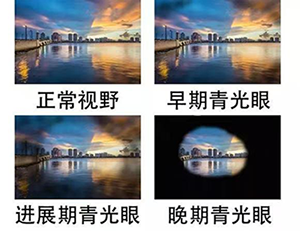 青光眼的“假象”：眼压正常也可能患病